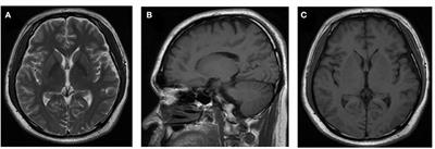Case Report: Metagenomic Next-Generation Sequencing Confirmed a Case of Central Nervous System Infection With Brucella melitensis in Non-endemic Areas